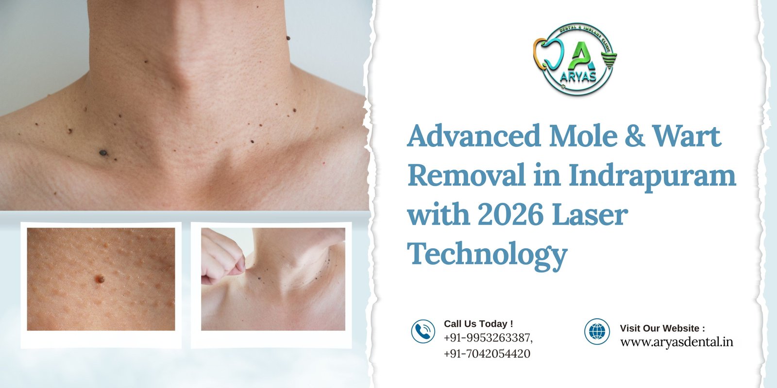 mole-wart-removal-in-Indirapuram-laser-treatment-2026-Aryas-Dental-Ghaziabad-Indirapuram